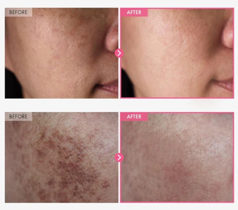 Buy 1 Get 1 Free Arbutin 7% + Tranexamic Acid 4% Anti Acne Cream